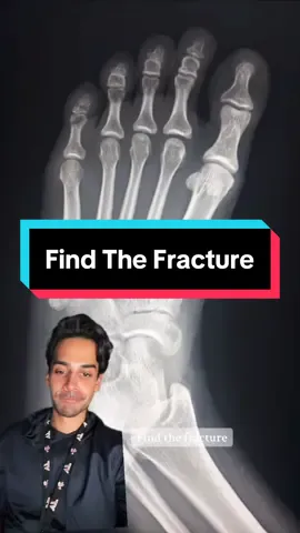 Find the fracture  #radiology #radiologytechnologist #radtech #medschool #medstudent #msk #orthopedics #emergencymedicine #xray #xraytech #fracture 