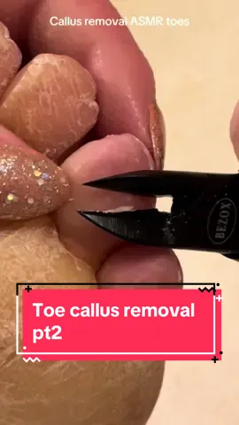 Imo the most satisfying one 😍 #callusremoval #parmeseanpalms #skinpicking #skinpeeling #dermatologist #podiatrist 