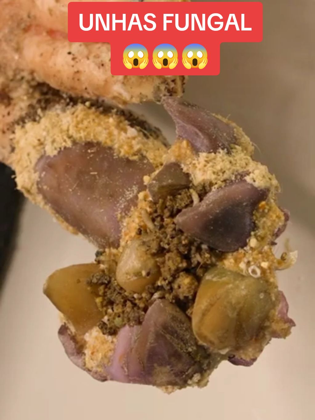 #CapCut #omg #pedicure #toenai #toenails #fungosnasunhas #omg #satisfying #podologia #podologo #fungal #unhas #podolog #podologa #unha 