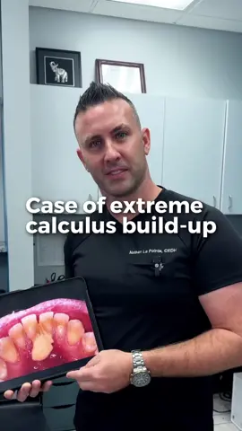 🦷Got rough spots on your teeth? That rough feeling could be calculus build-up, which can lead to gum recession and sensitivity if left untreated. 🦠 Thankfully, a tissue graft can cover the exposed area and ease discomfort. Want to keep your smile healthy? Follow us for more 💪🏻✨ #smileexperts  #toothhealth #healthysmile 