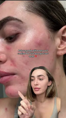 Ashwaganda IS NOT the best way to lower cortisol levels if you have acne prone skin !!!! #acneproneskin #acnetips #cortisol #cortisolimbalance #cortisolface #loweringcortisol 