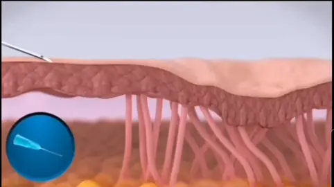 Fiber Cutting (Subcision) with Filler Injection, is commonly used to treat deep scars, facial indentations, and acne scars Technique Explanation  Fiber Cutting (Subcision) A fine needle is inserted beneath the skin, where the doctor moves the needle to cut the fibers that attach the skin to the underlying tissue. These fibers are responsible for pulling the skin down, creating deep scars or indentations. By cutting these fibers, the skin is freed, allowing it to rise to a more natural surface level, which helps in reducing the appearance of scars and indentations.  Filler Injection After fiber cutting, a filler substance (often hyaluronic acid) is injected into the targeted area. The filler helps fill in the sunken areas or indentations caused by acne or scars, providing a smoother, more even skin appearance Benefits of the Technique Effectively helps in treating deep scars Gives the skin a smoother and more even appearance. The treatment is relatively non-invasive and requires a short recovery period ?Are There Any Side Effects Some side effects, such as swelling or redness in the treated area, may occur but are usually temporary and disappear within a few days This technique is considered an effective treatment for acne scars and other types of scars, but it is best to have a proper evaluation to determine the most suitable approach for each individual. قطع الألياف (Subcision) مع حقن الفيلر، هالتقنية كتير بيستعملوها مشان يعالجوا الندبات العميقة، والحفر بالوجه، وآثار حب الشباب. 1. قطع الألياف (Subcision) بيستخدموا إبرة رفيعة بيدخلوها تحت الجلد، وبيحرّكها الدكتور لحتى يقص الألياف اللي بتربط الجلد بالأنسجة اللي تحت. هالألياف هي اللي بتشد الجلد لتحت، وبتعمل هالحفر أو الندبات الغميقة. لما بيقصوها، بيتحرر الجلد وبيطلع على مستوى السطح الطبيعي، وبيخفف من شكل الحفر والندبات 2. حقن الفيلر بعد ما يقصوا الألياف، بيحقنوا مادة الفيلر (مثل الهيالورونيك أسيد) بالمكان اللي بدو معالجة. الفيلر بيعبّي المناطق الغميقة أو الحفر اللي صارت من حب الشباب أو الندبات، وبيخلي البشرة شكلها أنعم ومتجانس أكتر ميزات التقنية بتساعد بشكل فعّال بعلاج الندبات الغميقة بتعطي مظهر للبشرة أنعم ومتجانس أكتر العلاج مو جراحي كتير وما بيحتاج وقت طويل للتعافي في آثار جانبية؟ ممكن يصير شوي تورم أو احمرار بالمكان اللي تعالج، بس عادة بتكون مؤقتة وبتروح بعد كم يوم هالتقنية تعتبر من الطرق الفعّالة لعلاج آثار حب الشباب والندبات، بس طبعاً لازم الدكتور يقيم الحالة ليشوف شو الأنسب لكل شخص #جلدية_تجميل #foryoupage #london #fyp #اوروبا #اكسبلور #جميع_الدول_العربيه #مشاكل_بشره #احدث_التقنيات_التجميلية #rufaida #وهيكا_يعني_🙂👍 