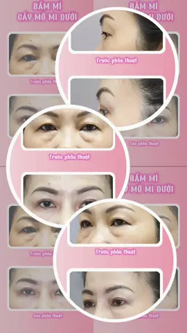 Trẻ hoá đôi mắt toàn diện khi kết hợp bấm mí và cấy mỡ mi dưới. --- ✧ Phòng Khám PTTM Lê Hành ✧  ・Địa chỉ: 83 Trần Thiện Chánh, P12, Q10, TP.HCM. ・Hotline: 0987 62 74 74 ・Website: https://drlehanh.vn/ #drlehanh #phongkhampttmlehanh #bacsilehanh #phongkhamlehanh #bammi #caymomoduoi 