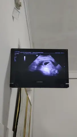 #9weeks #usg #detakjantungjanin #trimester1 #CapCut 