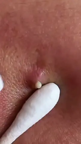#perfect 👌 #4you #satisfyingvideo #skincare #pimplepopping #4upage #viral_video #fyp #lovely #viralvideos 