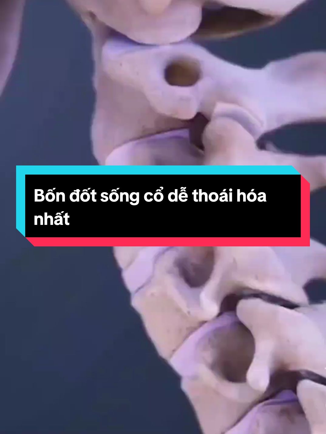 4 đốt sống cổ dễ thoái hóa nhất  #Thoáihoacotsong  #BsDyChiCuong  #chiropractic  #thoatvidiadem  #xuhuong #viral 