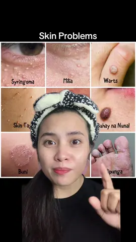 Ito na ang solusyon para hindi kana mapagastos ng mahal magpa derm. Magcheck out kana ng kasoy cream. #kasoycream #naturesmiraclewartsremoval #kasoycreamwarts #kulugoremover #milia #skintag #wartsremoval #trending #foryou #fyp #tiktokph 