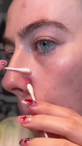 Pimple popping compilation🤩😻❤️ so satisfying🤩🤩🤩🤤🤤 #pimplepop #satisfying #foryou #pimple #relaxing #blackhead #squeeze #whiteheads 