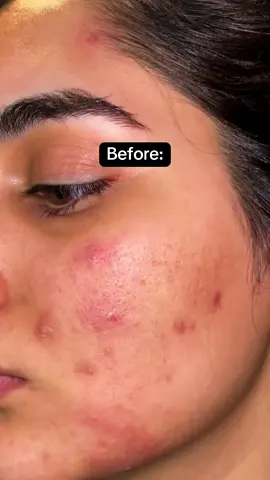 You’re welcome💛✨ #foryoupage #foryou #trending #skin #skincare #clearskin #acne #acneskin #asiangirl #desi 