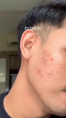 Kalo lagi ada acara penting, gue selalu pake hacks ini buat nutupin jerawat sih. So far dipake seharian juga ga luntur. Nyaman juga 👍🏻 #sunscreencowok #reviewsunscreen #skincarehacks #skincareroutine 