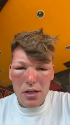 Suns had me right off  #thailand #sunpoisoning #kohphangan #raver #fyp #backpack #travel #wrong #wrongsreals 