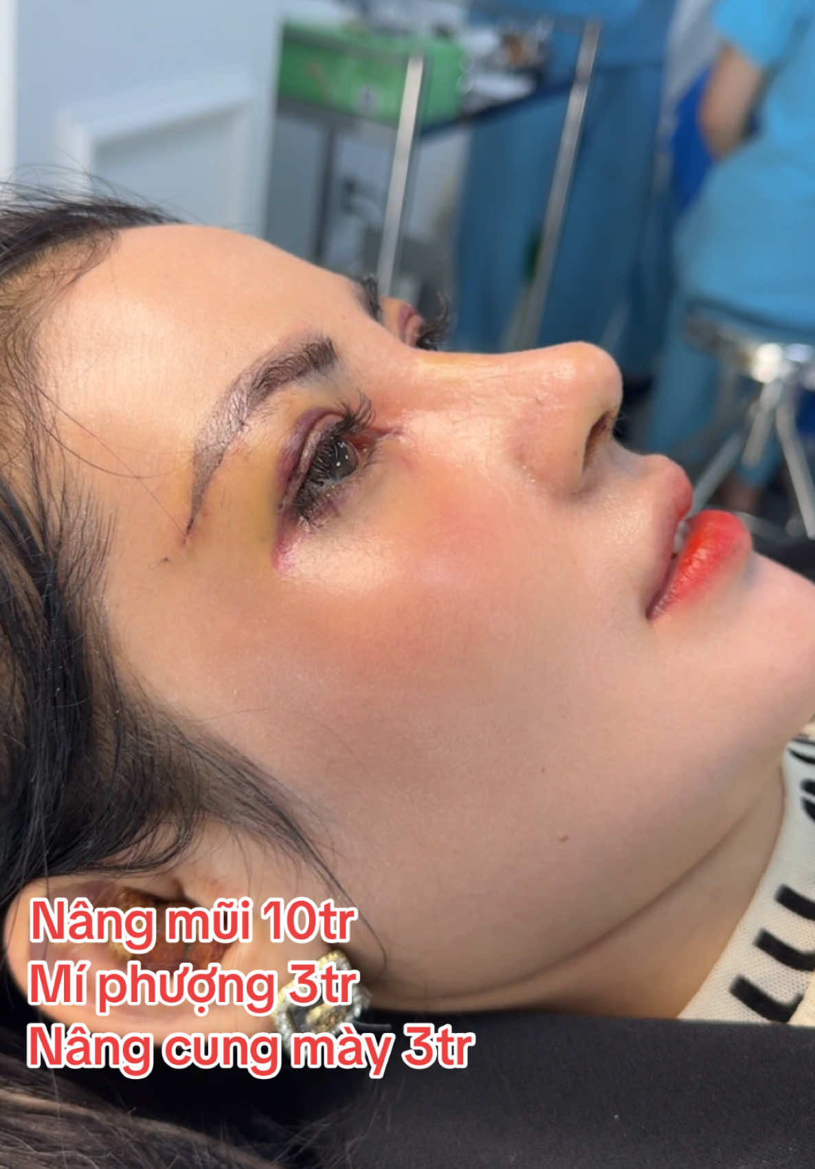 Combo Mũi Mí Nâng Cung đón tết bên anh Sơn, mọi người cảm nhận thế nào? #drson #suamuihong #nangmui #china #thailand #nangmuisline #goclamdep 