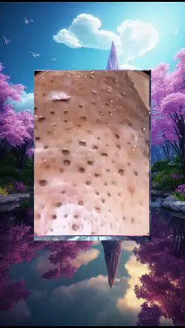 #acne #pimple #pimples #pimplepop #satisfyingvideo #pimplepopper #fyp