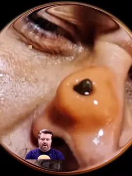 #asmr #foreingobject #removepimples #blackheadsremoval #satisfyingvideo #foryou 