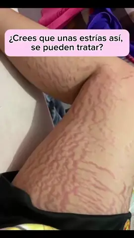 Estos cambios Medan escalofrío😍 somos un exito en el mercado ♥️#estrias #estriasembarazo #estriasblancas #estriasrojas #pypシ #pierna #entrepierna #cambiosreales #colombia 