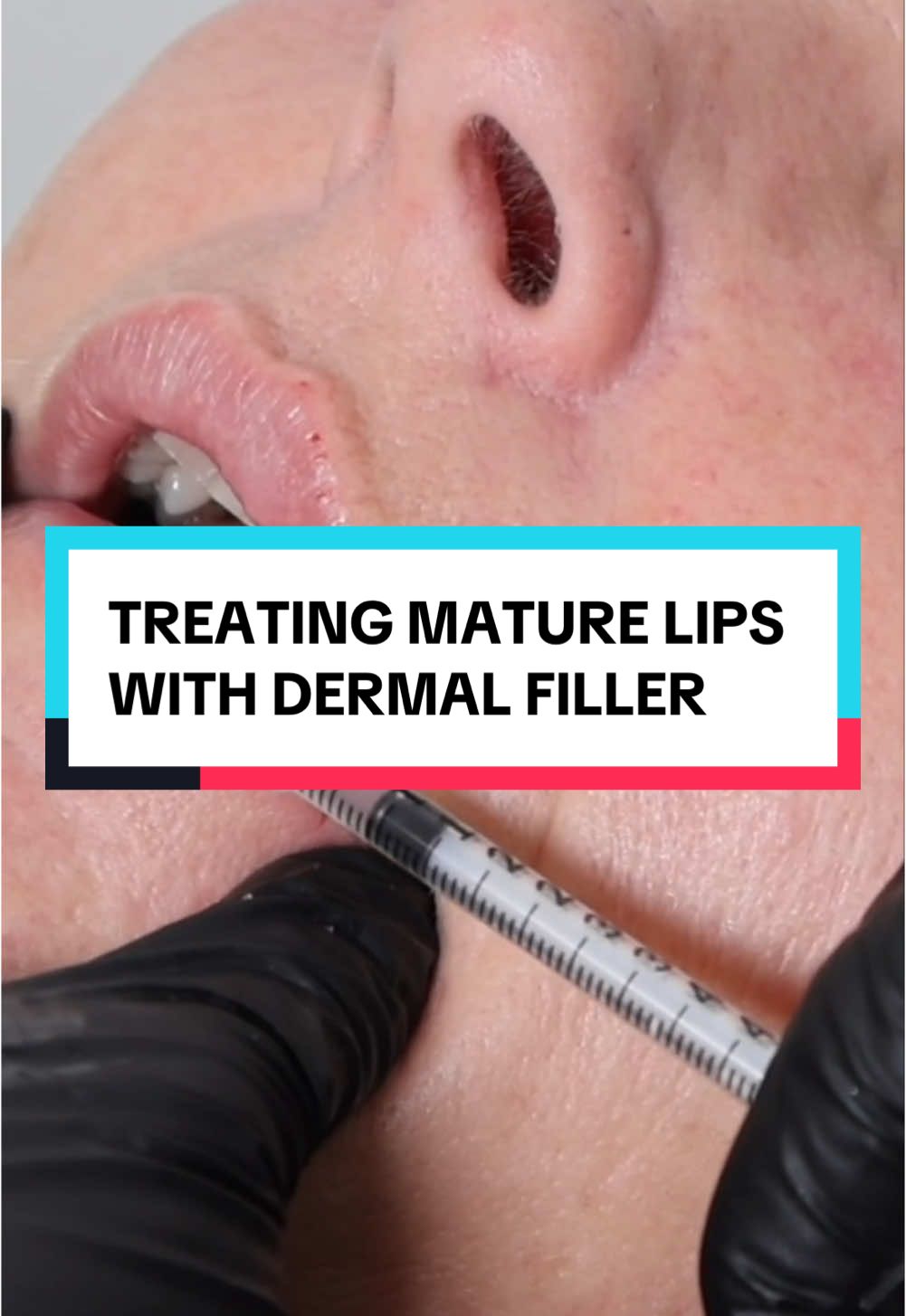 Treating mature lips with dermal filler!😍 join my members club for full access to all the tutorials #aestheticspractitioner #lipfiller #maturelips #maturelipfiller #dermalfiller 