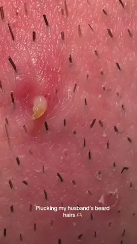 I just HAD to go back and squeeze this one!  #ingrownhair #pimple #beardhairplucking #beardtok #trichotillomania #satisfyingvideo #stranglysatifiying #sebaceousfilament #extractions #fypシ゚ #viralvideos 