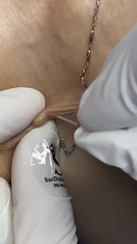 Trên cổ cũng có #sacdepspa #thuytruong #munmo #umo #relax #pimple #trimungovap 