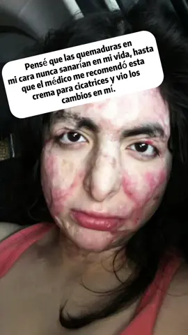 Get rid of those annoying scars and regain your smooth skin. You won't regret it! #scarremoval #TikTokBeauty #healing #skincare #effectiveproducts #tiktokshopblackfriday #blackfriday