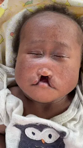 I month old Isa masanja needs your help for have surgery for cleft lip and palate, masanja's issue is an emergency and it's not easy for us to raise funds for his surgery. Currently masanja can hardly breastfeed or feed using even a normal bottle, if we can raise some of the funds early enough, we can probably help Masanja feed using the tube as we look forward to raising funds for him, let's all come together and work towards this chance, I give you confidence that if we all come together and donate anything small we can, in a short period of time, we could help masanja have this surgery. We created a gofundme for Masanja and the link to donate for him is pasted in our instagram bio, please visit and donate and still don't forget to share to create more awareness.💔🥹🙏@master.sanker 