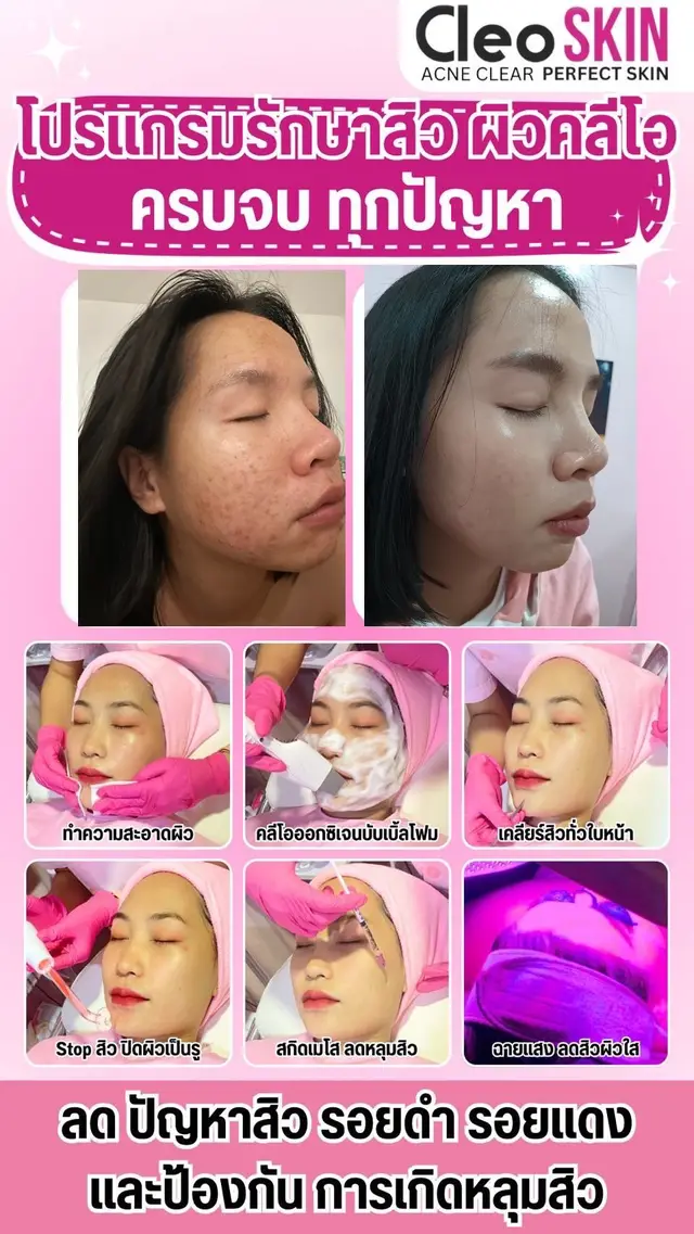ทุกปัญหาเรื่องสิวจบ#คลีโอสกินลําปาง #คลีโอรักษาสิว 
