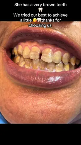 Thanks for choosing us #fup #fyp #teeth #teethwhitening #500k 
