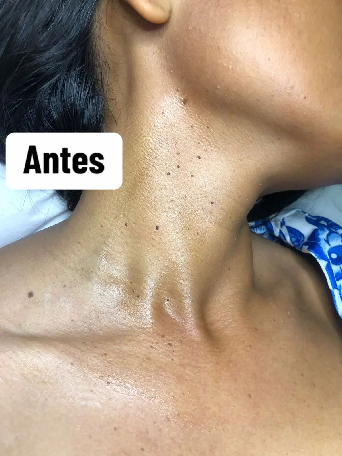 A remoção de sinais é um procedimento cada vez mais buscado por aqueles que desejam melhorar a aparência da pele e eliminar marcas indesejadas. Com o avanço da tecnologia, hoje é possível realizar esse tipo de tratamento de maneira segura, rápida e eficaz, oferecendo resultados naturais e duradouros. Além de questões estéticas, muitas pessoas procuram a remoção de sinais por motivos de saúde, já que alguns sinais podem se tornar suspeitos e requerer monitoramento ou retirada para evitar riscos maiores, como o câncer de pele. O processo de remoção pode ser realizado através de diferentes técnicas, como a cirurgia convencional, laser ou crioterapia, dependendo das características do sinal e das necessidades do paciente. A escolha do método mais adequado deve ser feita por um dermatologista especializado, que levará em consideração a localização, o tamanho, a profundidade e a forma do sinal, garantindo um procedimento personalizado e eficaz. Além dos benefícios estéticos e de saúde, a remoção de sinais pode ajudar a aumentar a autoestima, proporcionando mais confiança para quem sente desconforto com marcas no corpo ou no rosto. O procedimento é minimamente invasivo e, na maioria dos casos, permite uma recuperação rápida, com riscos baixos de complicações. Para quem deseja realizar a remoção de sinais, é fundamental buscar um profissional qualificado, que tenha experiência no procedimento e possa oferecer orientações claras sobre cuidados pós-operatórios, garantindo resultados satisfatórios e seguros. #RemoçãoDeSinais #SaúdeDaPele #Dermatologia #CuidadosComAPele #Laser #CirurgiaDermatológica #Estética #Autoestima #SaúdeEBeleza #CâncerDePele #tratamentosdermatologicos 