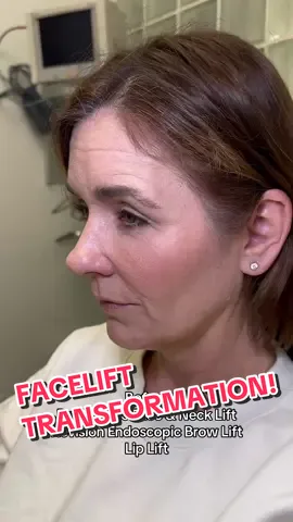 “I have a 7 year old son and didn’t want to look like his grandma. This was the best decision ever I wish I had done my facelift years ago!!! Dr. Kassir you truly are an artist and made me look 20 years younger! I can not thank you enough for changing my life ❤️” says our lovely patient 6 months post-op.  Our amazing 51 year young patient came from Connecticut for facial rejuvenation. She was gracious enough to be apart of our Facelift Master Course and live streamed her whole surgery to our 40+ international 🌍 attendees.  She previously had a Brow Lift (done elsewhere) and it was not successful. Her brows were left droopy & not elevated at all. We performed a Revision Endoscopic Brow Lift to position her brows at a more aesthetic level and open up her eye area.  We then performed a Deep Plane Face & Neck Lift to address the jowling she had and give her a defined jawline and elevated mid-face.  Lastly we did a Lip Lift to shorten the long distance between the upper lip and tip of the nose. This gives a aesthetic lip shape & youthful look. Concerns ⬇️ - She disliked her droopy midface  - Forehead wrinkles  - Excess neck skin  - Heavy brows  - Long distance between upper lip & tip of the nose  Game Plan ⬇️ We performed the following procedures to give her a natural & fresh look: 1️⃣ Deep Plane Face & Neck Lift 2️⃣ Revision Endoscopic Brow Lift 3️⃣ Lip Lift She is now 6 months post-op and is in love with her results! She feels great & love how natural her results are. We will continue to keep track of her healing and show you all the progress! Stay tuned for her follow up pictures 🤗 To schedule an appointment:   ☎️ 212-288-3000  📲 WhatsApp: 201-875-8482 💌DM  Locations: 📍65 East 66th Street, New York, NY 10065 📍81 North Maple Avenue, Ridgewood, NJ 07450 #bestfacelift #facelift #faceliftnyc #faceliftnj #necklift #faceliftbeforeandafter #over50 #faceliftjourney #faceliftrecovery #beforeandafterfacelift #faceliftrecovery  #scarsafterfacelift #viral  Disclaimer: I do not own or claim to own the audio in this video. All rights and permissions are granted to the owner of this sound.