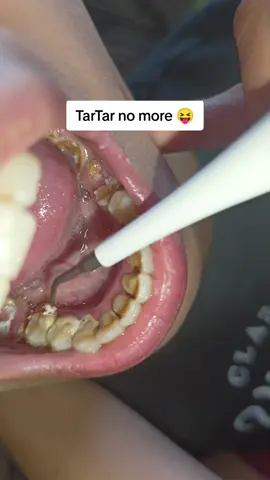 satisfying video 🥰😘  #tartar #tartarremover #electricteethcleaner #hot #fyppppppppppppppppppppppp #fypage 
