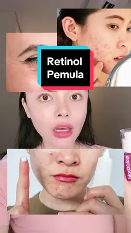 Cara pakai retinoid apa pun itu sama aja ya prinsipnya seminggu sekali dulu dan harus ada basic skincare ya biar skin barrier kamu ga rusak. Contoh masalah kulit yang bisa diatasi dengan retinol : flek (PIH), kerutan halus, jerawat ringan, jerawat on off ringan, warna wajah tidak rata. Brand di video ini glad2glow harga 40k sudah uji lab. #retinol #retinoid #pemula #teksturkulit #kerutanhalus #skincare #pemulafriendly #sensitiveskin #acne #bekasjerawat #pie #rekomendasiretinol #serum #glowing