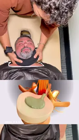 ✨ Asena Hanım (@asenaofficial) ve Hasan Dere (@hasandere_) çifti yine misafirimizdi… 🕊️ Onca teknik uyguladık ama Hasan Bey özellikle bu manipülasyonda oldukça rahatladığını söyledi 😊 💆‍♂️ Bu yöntem, atlas omuru çevresindeki gerilim ve yapışıklıkları açarak rahatlatan, traksiyon (çekme) prensibine dayalı özel bir manipülasyon tekniğidir. 🩻 Manuel terapi ve kayropraktik tekniklerden farklı olarak, kendi geliştirdiğimiz bu yöntemle boynun en üst omurlarına odaklanıyoruz. Sinir sistemi ve omurga dengesi üzerinde güçlü bir etki yaratmayı amaçlıyoruz. 🎯 Atlas kemiği, sinir ve dolaşım sisteminin merkezi olarak vücut sağlığında kritik bir rol oynar. Bu bölgedeki açı bozuklukları, birçok kronik problemin temelinde yatabilir. 🪢 Blokajları bir düğüm gibi düşünmek gerekirse, her danışan için bu düğümleri çözmek amacıyla çeşitli açılardan müdahale ediyoruz. Kişinin ihtiyaçlarına göre özel yaklaşımlar uyguluyoruz. ✅ İşitme kaybı, migren, vertigo, baş ağrıları ve tansiyon gibi birçok sağlık sorununda bu yöntemin olumlu etkilerini gözlemliyoruz. Atlas Terapi ile hedefimiz, bu bölgedeki düğümleri çözerek sinir sisteminin ve omurganın rahatlamasına katkıda bulunmak. 👍🏼 Sadece bir bölgeye odaklanmaktan öte, vücudun genel işleyişini destekleyen bir terapi süreci sunuyoruz. 🎥 Videodaki animasyon, vertebra arasındaki diskin üzerindeki baskının azalması ve iyileşme sürecini gösteriyor. Bu iyileşme süreci, yaklaşık 6 ay boyunca, iyileşmeyi yavaşlatacak sigara gibi etmenlerden uzak kalındığında görülebiliyor. 💯 Bu teknik, yıllar içinde edindiğimiz deneyim ve dokunarak (palpasyonla) yaptığımız detaylı analizlerle şekillendi. Diğer birçok manuel terapistin veya kayropraktörün ulaşamadığı sonuçlara, bu odaklanmış teknik sayesinde ulaşıyoruz. ⚠️ Her bireyin yaşadığı problemler, omurga ve sinir sistemi yapısına göre dikkatlice ele alınıyor ve seans öncesi ayrıntılı değerlendirmelerle en doğru yaklaşımı belirliyoruz.