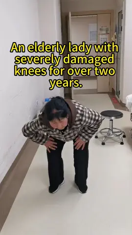 An elderly lady with severely damaged knees for over two years.#fyp #kneepain #physicaltherapy #sports #older #KDBRACE 