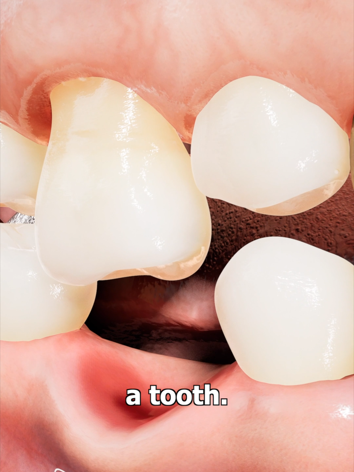 Why Your Jaw Shrinks After You Lose a Tooth & Why You Should Get a Dental Implant 🦷🦷🦷  #dentist #dentistry @jimimoso_official