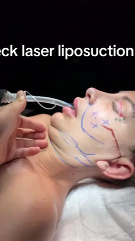 Neck laser liposuction- double chin deformity fixing  #foreheadreduction #barbienose #hairlinelowering #hairlineloweringsurgery #cateyessurgery #foxeyessurgery #rhinoplasty #necklaserliposuction 