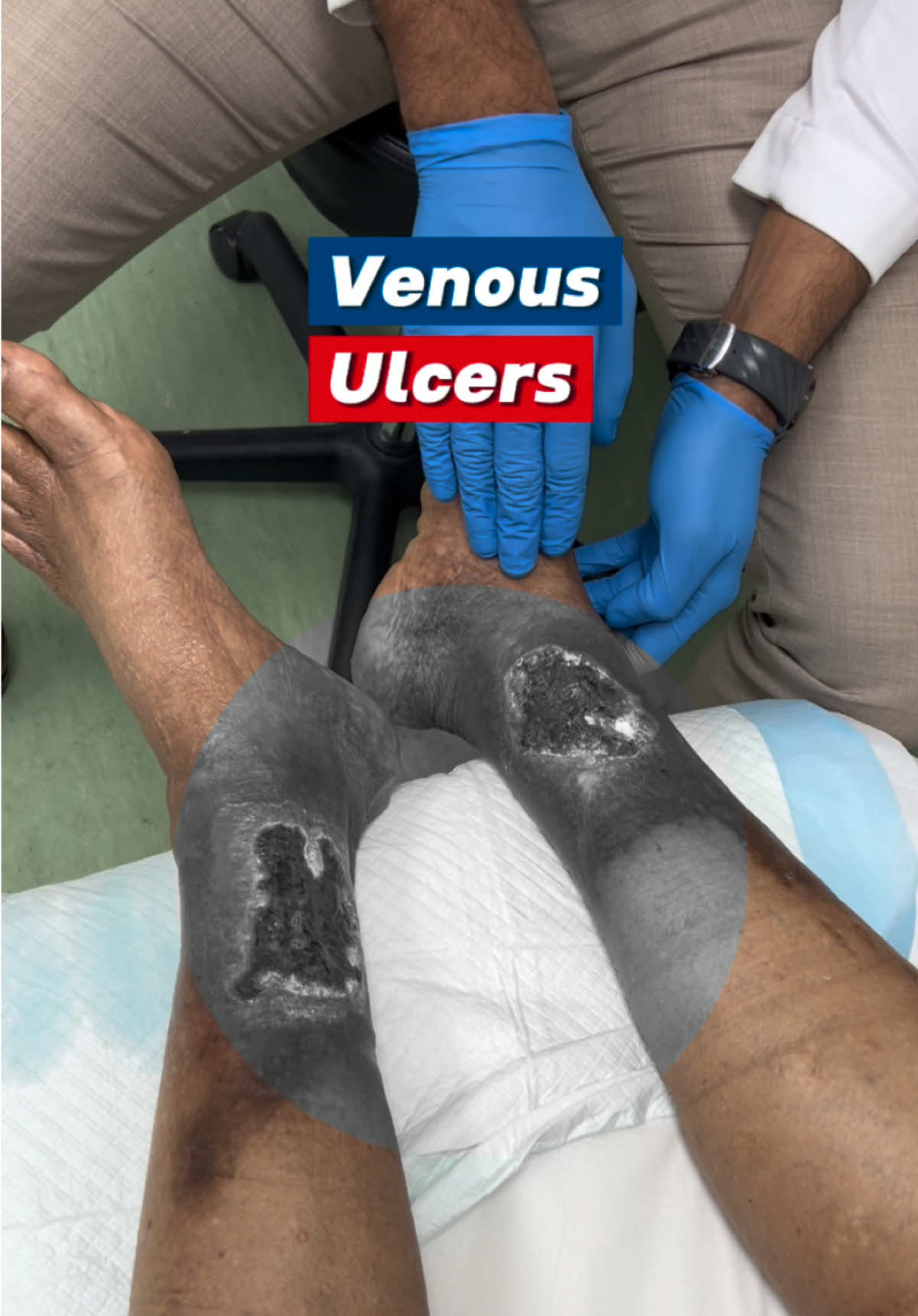 Healing venous ulcers is a journey but it can be done with the appropriate management👍🏽✨              #trini_tiktoks #varicoseveins 