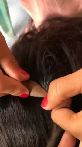 #lice #liceremoval #omg  #fyp 