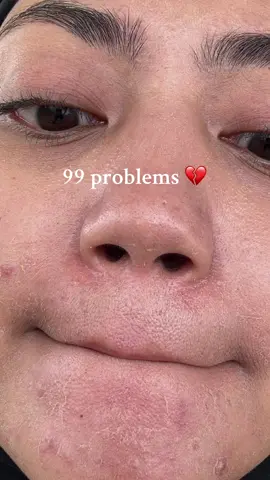 911 emergency kalo kulit lagi ngamuk💗  #acnebestie #acnaway #safeforacneskin #acne #acnawaymugwortgelmask #fyp #fypage #4u #foryoupage 