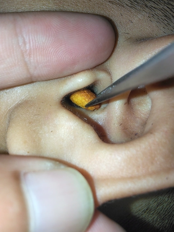 #relaxing #foryour #satisfyingvideo #earwaxremoval #asmr #earcleaningvideos #earwaxcleaning #earwax #ear 