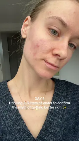 #acne #blemishes #skincare #acneskin #acnefighter #pimple #acneproneskin #hormonalacne #skinpicking #hormonalacnejourney #acnejourney #betterskin #acnescars #cysticacne #challenge #drinking #water  #drinkenoughwater #drinkwater 