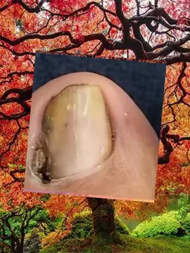 #toenail #ingrowntoenail #toenailremoval #nails #satisfying