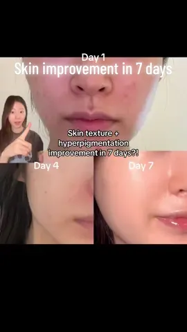 The way my skin improved SO FAST✨@YUREELAB_official #yureelab #spiculeserum #microneedling #skincare #skincareroutine #newproduct #skincaretips #koreanskincare 