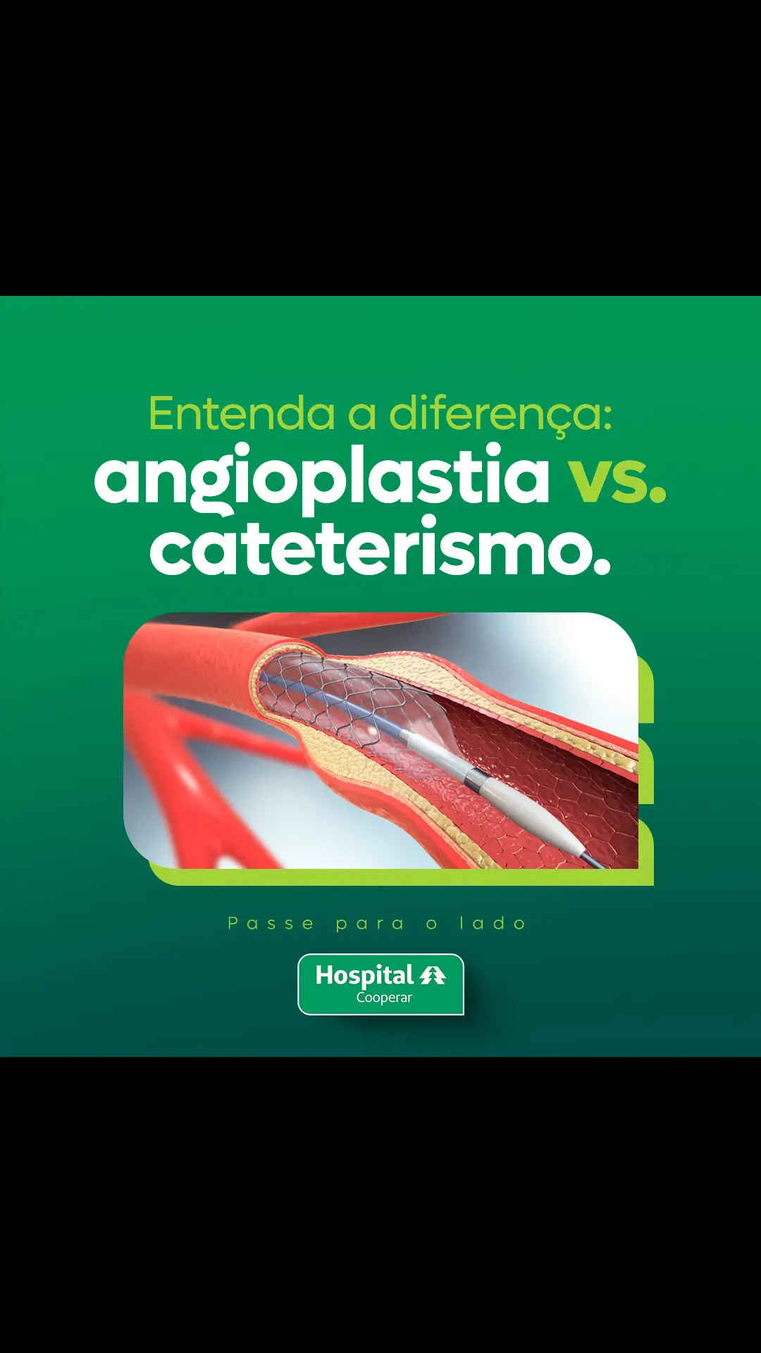 Você já sabia sobre a diferença entre os dois procedimentos? ▪Cateterismo é geralmente o primeiro passo para diagnosticar problemas cardíacos. ▪Angioplastia é realizada após o cateterismo, se necessário, para tratar os bloqueios. No Hospital Cooperar, estamos prontos para cuidar do seu coração com tecnologia de ponta e uma equipe especializada na área de cardiologia.