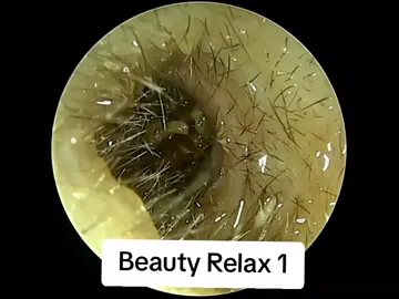 Ear wax removal part 1  #waxigvideos#removal #wax #extraction#explore #fouryoupage 