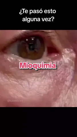 Se llama mioquimia. Es un movimiento involuntario de fibras musculares, comúnmente observado alrededor de los ojos (como el párpado) o la cara. Aunque suele ser inofensiva, puede ser molesta. Se asocia frecuentemente con factores como estrés, fatiga, consumo excesivo de cafeína, deshidratación o falta de sueño. En la mayoría de los casos desaparece por sí sola, pero puedes aliviarla reduciendo el estrés, durmiendo más y limitando el consumo de cafeína. Además, algunos estudios sugieren que el magnesio puede ayudar, ya que este mineral es importante para la relajación muscular. Si la mioquimia persiste por varias semanas o afecta otras partes del cuerpo, podría ser señal de un problema neurológico y sería recomendable consultar a un médico. #SaludMuscular #Mioquimia #Relajación #CuidadoDeLaSalud #Magnesio 