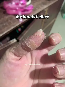 My eczema journey, finally after 1 year magaling na. #eczemajourney ###eczema #fyppppppppppppppppppppppp 