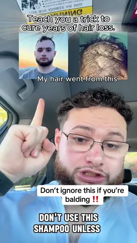 Teach you a trick to cure years of hair loss.#haircare #hairtok #hairstyle #alopecia #rosemary #Shampoo #HAIR #haircareroutine #grow #hairtutorialsvideos #hair#fyp#foryoupageofficiall#tiktokshopblackfriday#tiktokshopcybermonday#haircut
