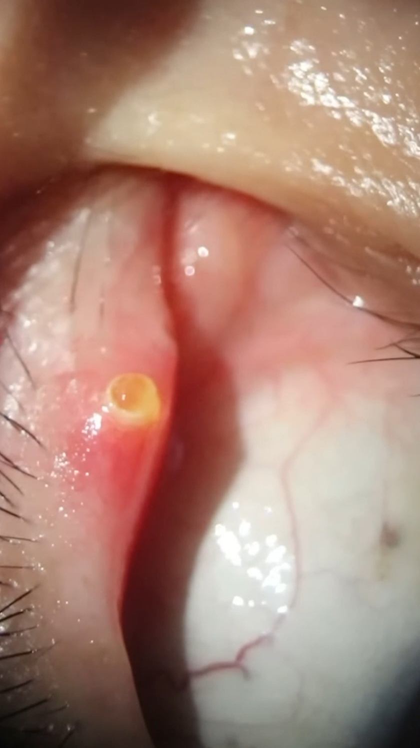 satisfying eye infections asmr removal 