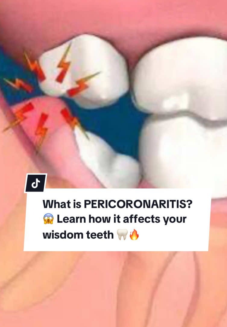What is PERICORONARITIS? 😱 Learn how it affects your wisdom teeth 🦷🔥 Pain while chewing? It might be pericoronitis, a common inflammation that happens when your wisdom teeth try to erupt but stay partially covered by gum tissue. Watch to see how it happens and why you should visit your dentist before it gets worse! #OralHealth #Dentist #WisdomTeeth #Pericoronitis #LearnWithMe #DentalTips #Viral #DentalCare #HealthySmile #OralHealth #DentistTips #WisdomTeethProblems #Pericoronitis #DentalCare #HealthySmile #ToothPain #WisdomTeeth #SmileCare #TeethHealth #3DAnimation #LearnWithMe #DentalHygiene #ToothCare #DentalTips #ViralVideo #HealthTips #MouthCare #dentaleducation 