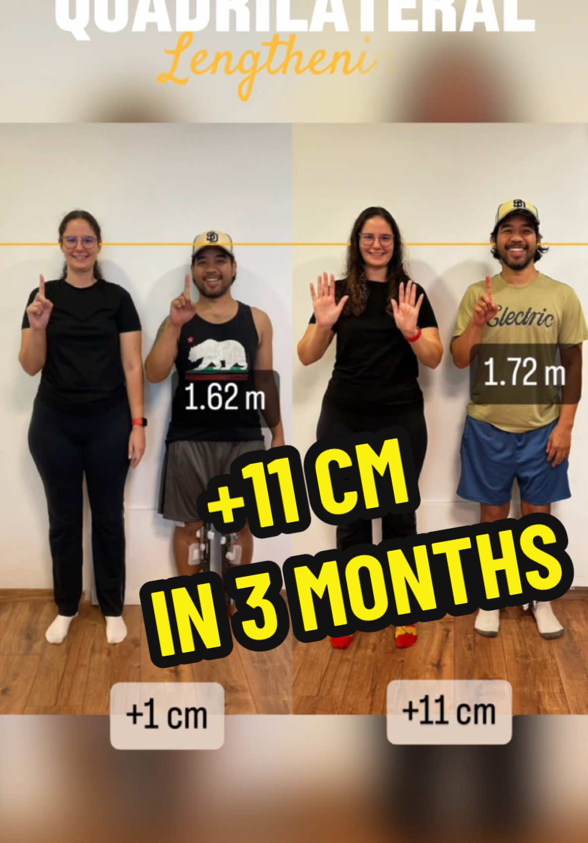 1.61 m ➡️ 1.72 m #limblengthening #beforeandafter #heightproblems #shortpeopleproblems #fyp #fy #livelifetaller 