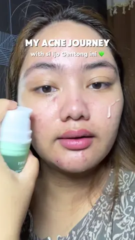 my acne journey with si ijo gentong moistnya glowsophy ☺️🥰 #Glowsophy #moisturizer 